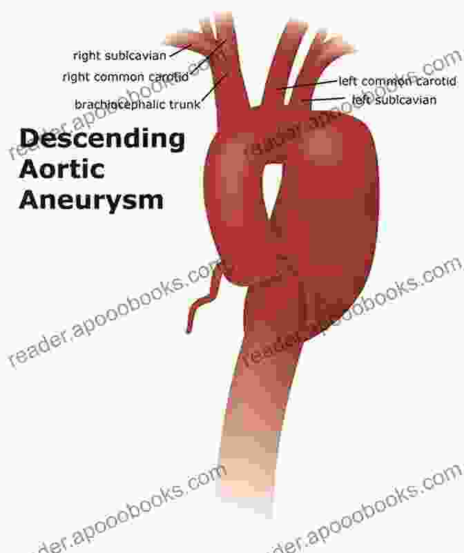 Aortic Aneurysm Aortic Aneurysms: Pathogenesis And Treatment (Contemporary Cardiology)