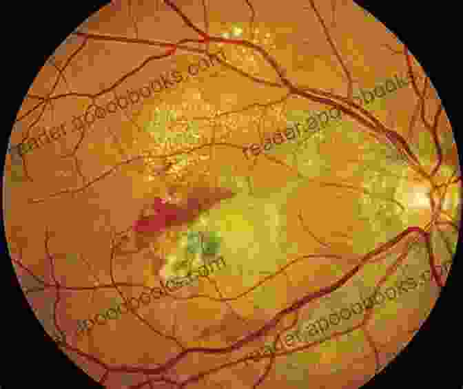 Choroidal Neovascularization Choroidal Neovascularization Kelly Harms