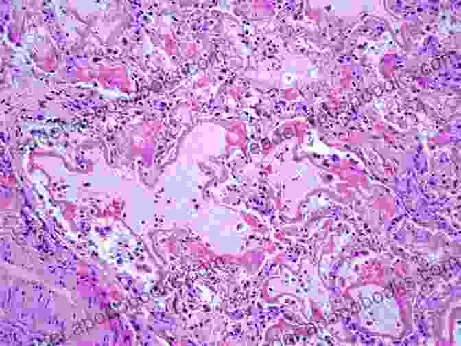 Microscopic View Of ARDS Affected Lung Tissue Acute Respiratory Distress Syndrome Justin L Lockman