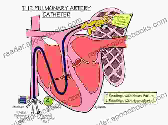 Pulmonary Artery Catheterization For ARDS Monitoring Acute Respiratory Distress Syndrome Justin L Lockman