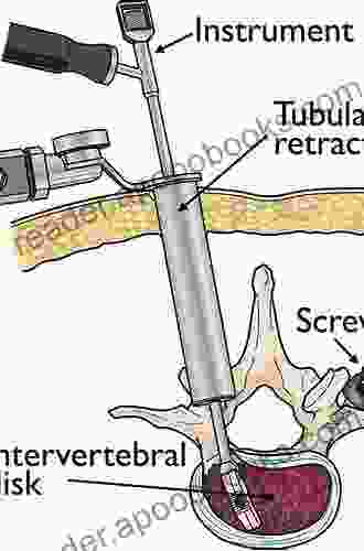 Instrumentation For Minimally Invasive Spine Surgery